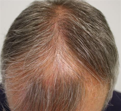 It may happen on any part of the body. Alopecia Androgénica Masculina - Hombres, Causas, Solucion ...