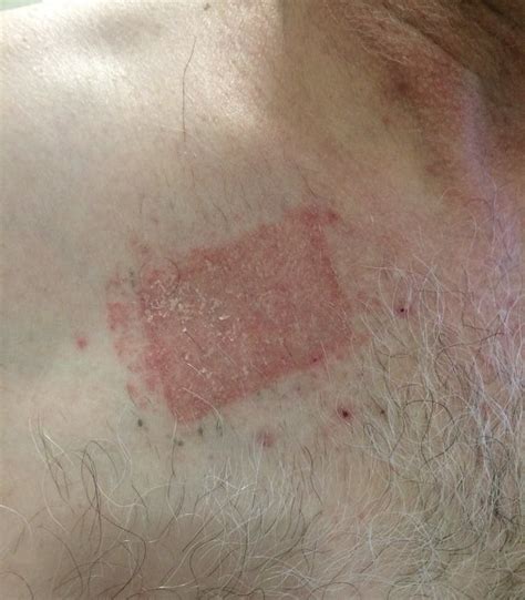 Common Skin Rashes And What To Do About Them — Richard Lebert