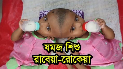 বাংলাদেশে জোড়া মাথার জমজ শিশু রাবেয়া ও রোকেয়া Bangladeshi Twins