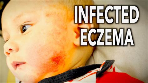 Cute Baby With Infected Rash Eczema Dr Paul Youtube