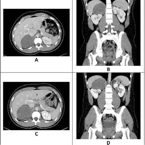 Contrast Enhanced Ct Scan Of The Abdomen And Pelvis In A Axial And