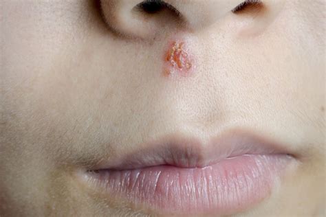 How Long Does It Take Cold Sores To Heal Rhodes Entenight