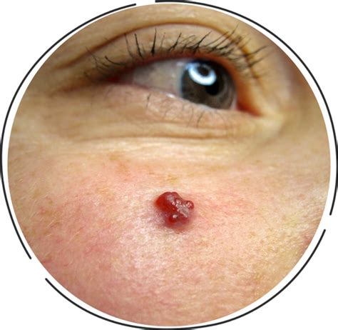 Jojo Bentley Skin Cherry Angioma Pictures How To Remove Cherry Angiomas Red Moles The