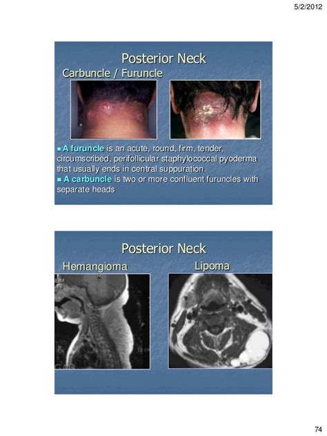 Clinico Radiological Approach For Diagnosis Of Neck Swellings