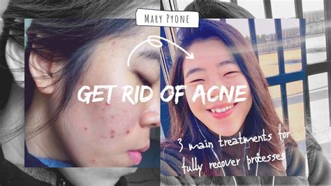 How I Get Rid Of My Acne And Cleared My Skin Youtube