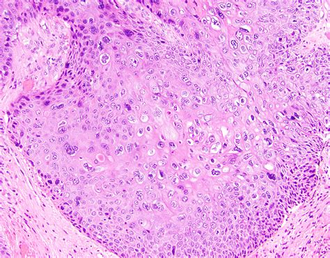 Superficial Squamous Cell Carcinoma