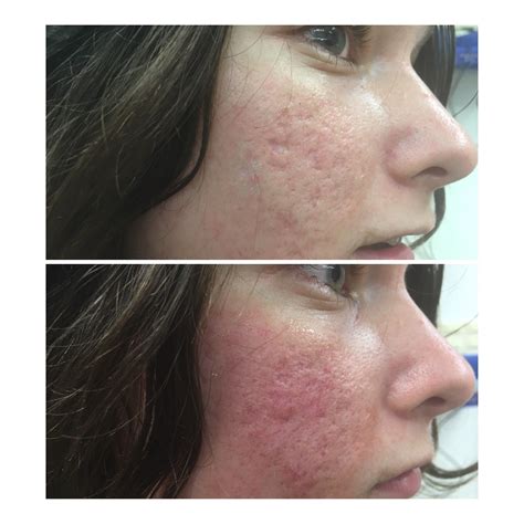 Co2 Laser Scar Removal Before And After