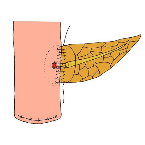 Suspension Pancreatic Duct Jejunum End To Side Continuous Suture The
