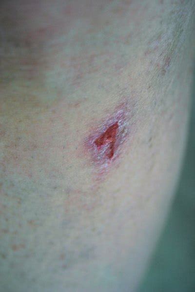 Antibiotics Recommended For Infected Wounds LIVESTRONG COM