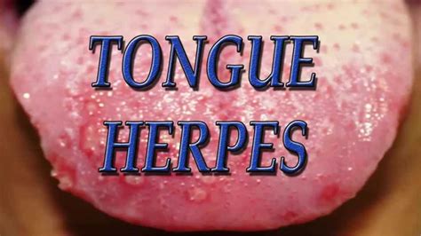Tongue Herpes Herpes On Tongue Tongue Herpes Cure Youtube