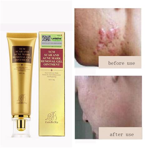 Acne Scar Removal Cream Is Rated The Best In 042024 Beecost