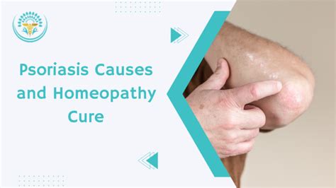 Psoriasis Causes And Homeopathy Cure Provitale Health Homeopathy