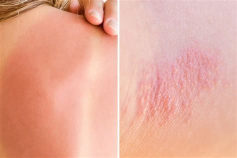 Heat Rash Or Sunburn Here’s How To Tell The Difference The Healthy