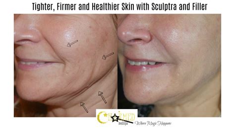 The Powerful Combination Of Fillers And Sculptra Charmed Medispa