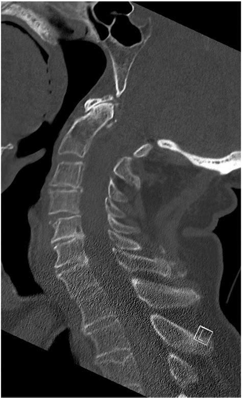 Unstable Cervical Spine Fracture With Normal Computed Tomography