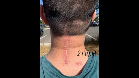 My Scar After 2 Months Of Posterior Cervical Decompression And Fusion