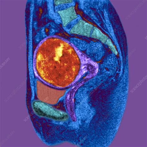Uterine Fibroid Mri Scan Stock Image M8500547 Science Photo Library
