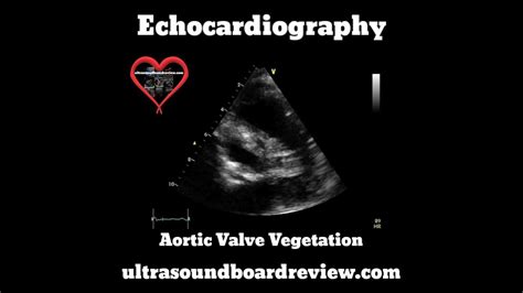 Aortic Valve Vegetation Youtube