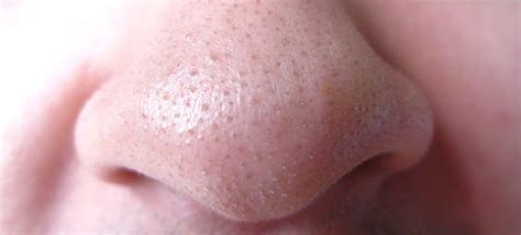 Home Remedies For Clogged Pores Howrid 5925