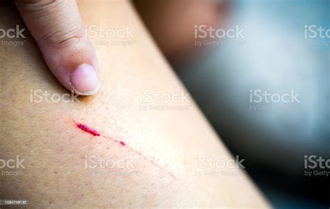 Closedup Of A Scratch Fresh Wounds On Shin Concept Of Accident