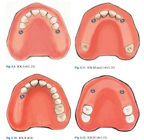 Implant Corrected Kennedys Classification Of Partially Edentulous Spaces