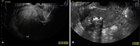 Ultrasound Images Of The Submucosal Fibroid A Initial Transverse