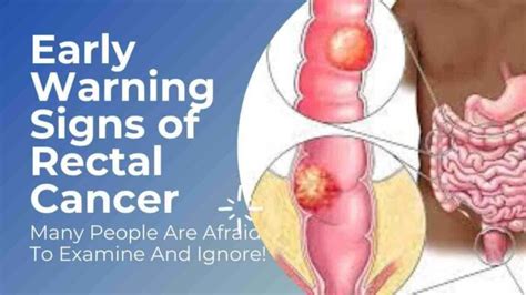 6 Early Warning Signs Of Rectal Cancer Unfortunately Many People Are