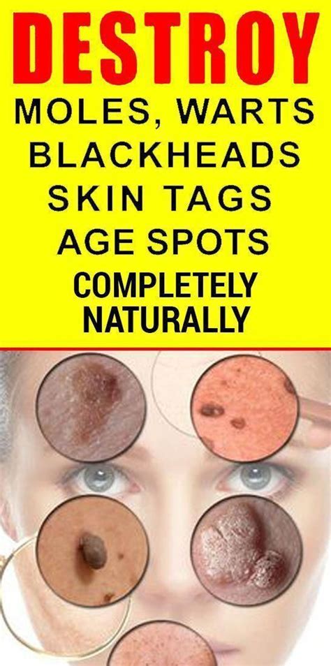 how to remove moles warts blackheads skin tags and age spots completely naturally