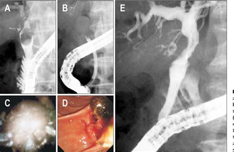 Figure 1 From Electrohydraulic Lithotripsy For Difficult Bile Duct