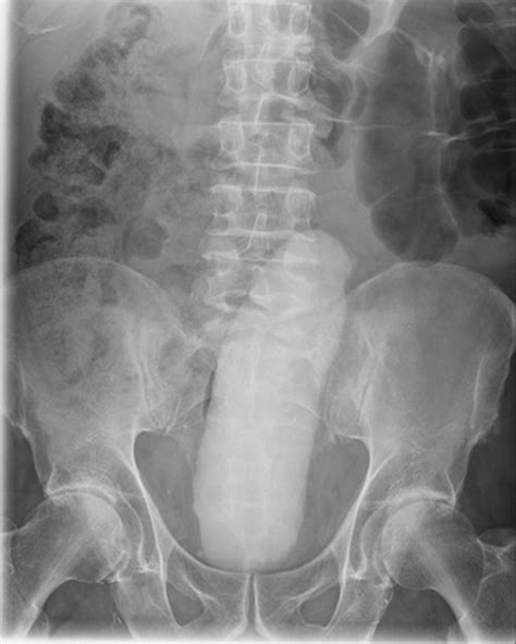 Plain Radiograph Demonstrating Rectal Foreign Body Download