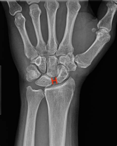 Traumatic Wrist Injury Radiology U Of U School Of Medicine