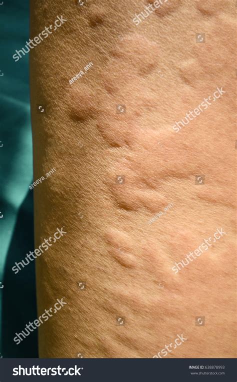Skin Rash Urticaria Allergic Skin Reaction Stock Photo Edit Now 638878993