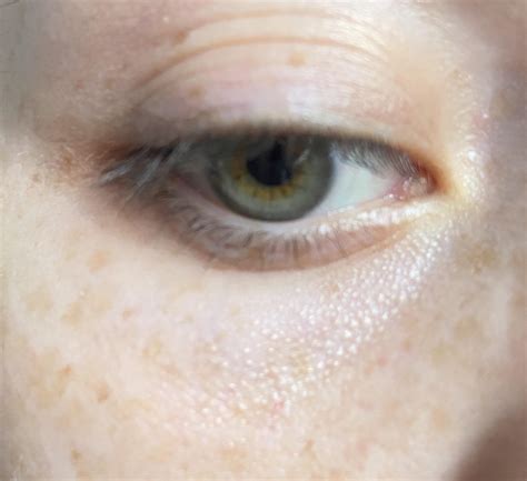 White Spots On Skin Under Eyes