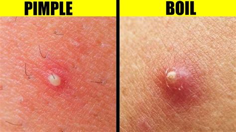 Mprumuta Ax Protec Ie Difference Between Boil And Pimple Afirma Explicit De