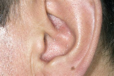 Psoriasis In The Ear Stock Image C0085733 Science Photo Library