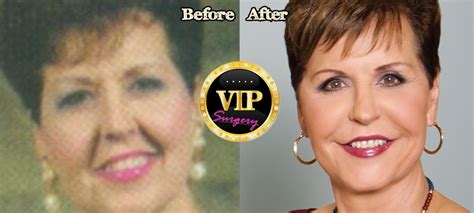 Plastic Surgery Face Lift Recovery Time Zone Plastic And Reconstructive Surgery E