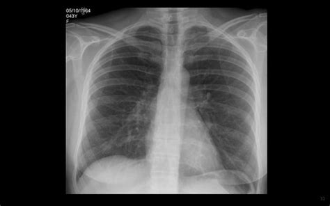Intermittent Chest Pain And Dyspnoea On Lying Down Any P Flickr