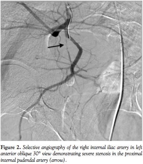 Angiography And Endovascular Revascularization Of Pudendal Artery
