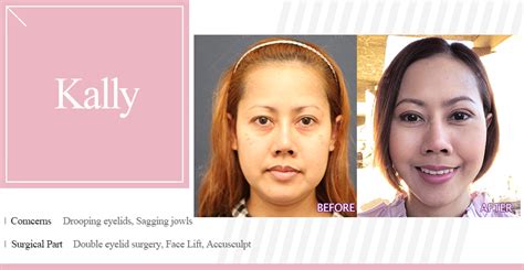Double Eyelid Full Incision Accusculpt Lift Jowl Neck Face Lift By