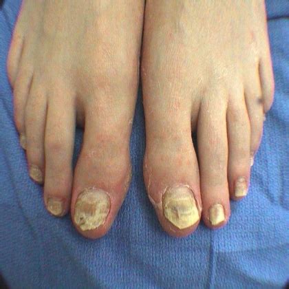 Vietnamese coriander also works for fungus between your toes. How To Treat Toe Fungus - Treat Toe Fungus Effectively ...