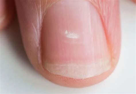 Review Of Why Are White Spots Appearing On My Nails References Fsabd42