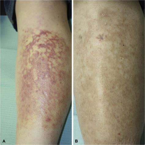 T Cell Lymphoma Rash Pictures Cutaneous T Cell Lymphomas With