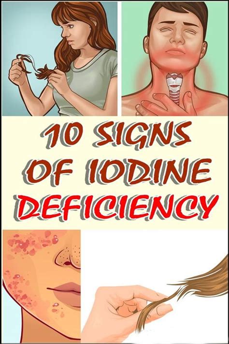 10 Signs Of Iodine Deficiency Iodine Deficiency Iodine Iodine
