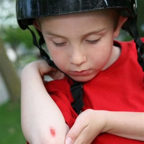 Cuts And Scrapes How Do I Know If My Child Needs Stitchessouthern