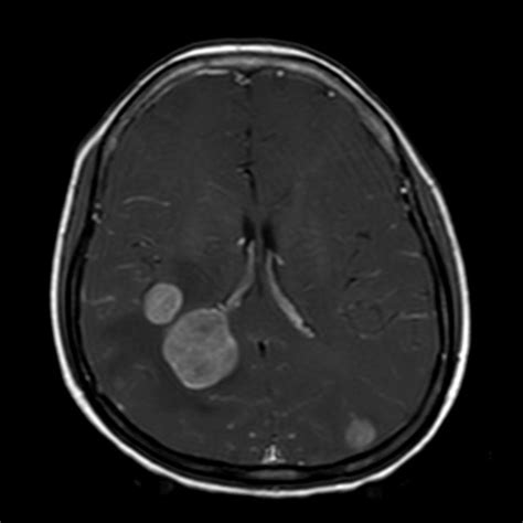 Lung Cancer With Brain Metastases Three Enhancing Lesions Seen On