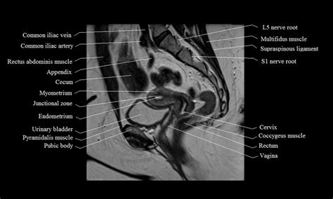 MRI Female Pelvis Anatomy Free MRI Sagittal Cross Sectional Anatomy Of Female Pelvis