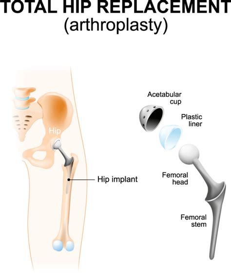 Hip Replacement Surgery Total Hip Arthroplasty Schulze Orthopedics