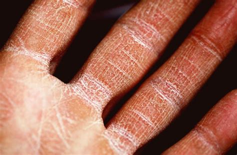 Dry Skin And Itching Overview Causes Symptoms Treatment