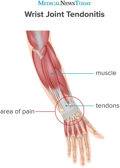 Forearm pain relief cause and treatment these pictures of this page are about:forearm muscles and tendons. Wrist tendonitis: Treatment, symptoms, causes, and more