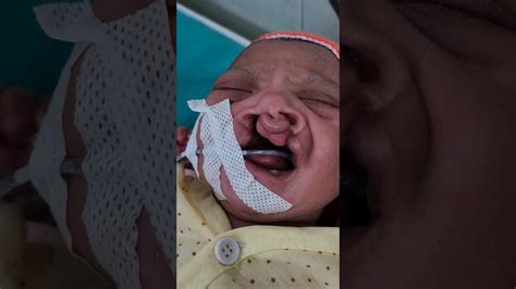 Cleft Lip And Cleft Palate In Newborn Baby Cleftlip Youtube